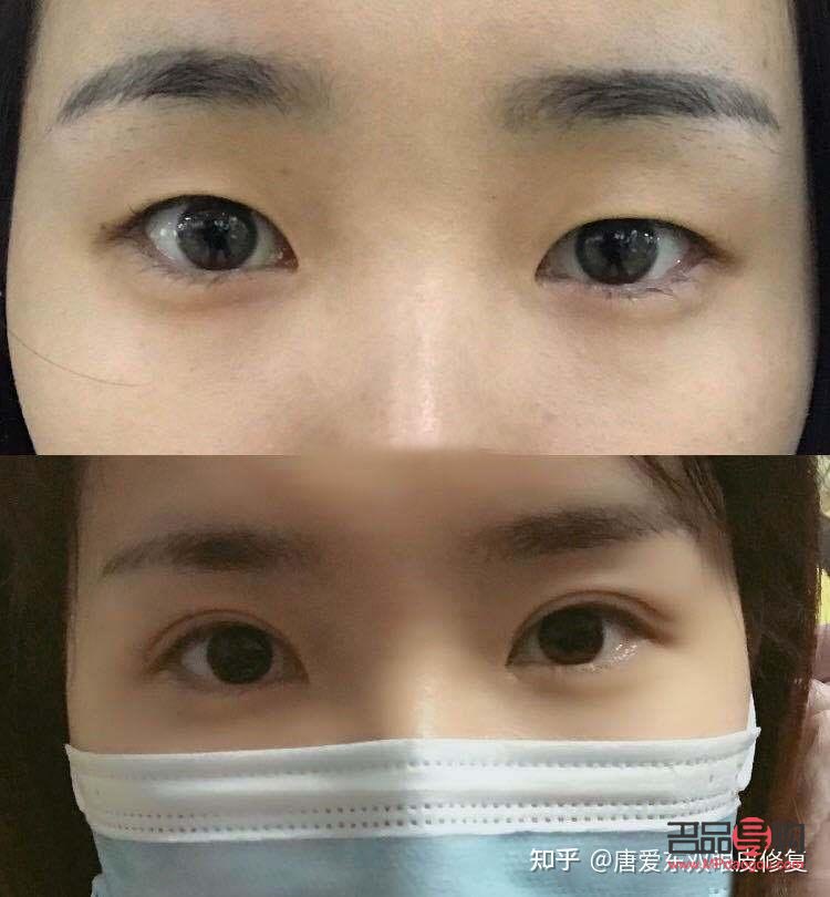 单眼皮肿眼泡怎么消肿(单眼皮肿眼泡怎么消肿最快方法) 单眼皮肿眼泡怎么消肿(单眼皮肿眼泡怎么消肿最快方法)