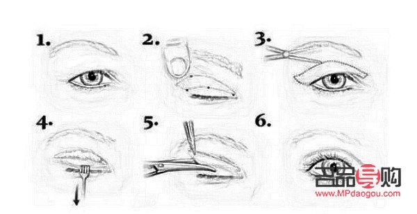 双眼皮手术费用知多少