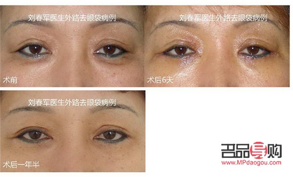 眼袋手术后的增生一般都能消失吗(眼袋手术后的增生一般都能消失吗图片) 眼袋手术后的增生一般都能消失吗(眼袋手术后的增生一般都能消失吗图片)