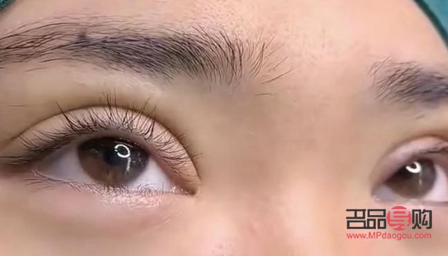 双眼皮翘睫术前后图片(翘睫术是怎么做的)