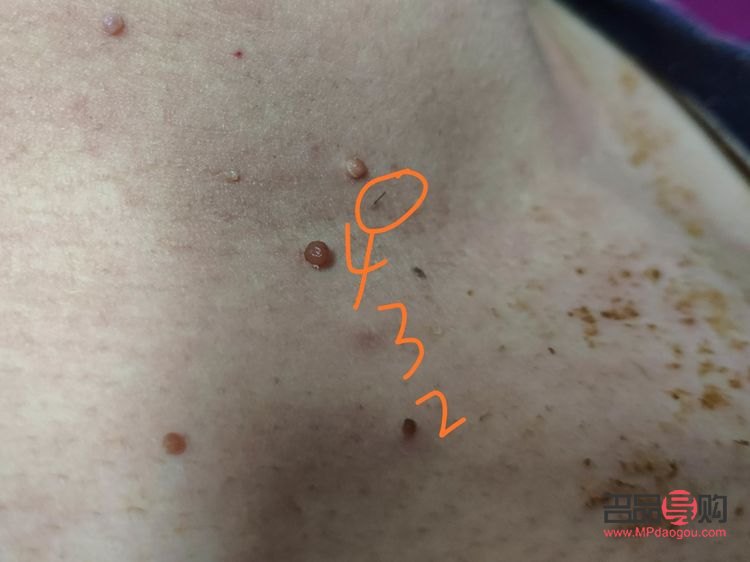 <h3>长疣怎么身体护理</h3>