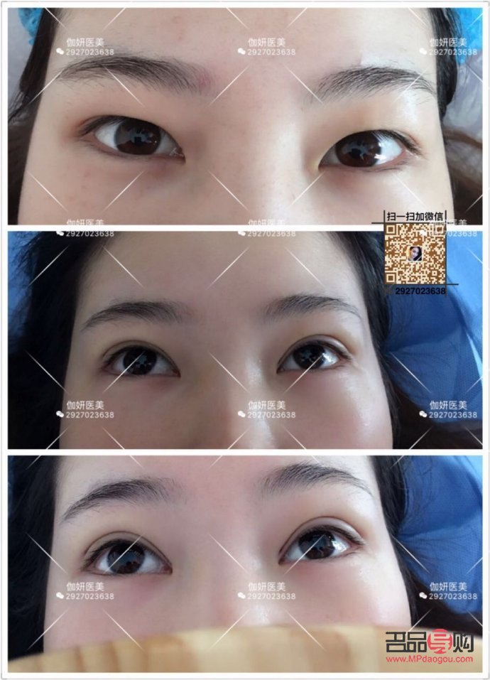 韩国纳米无痕双眼皮是什么技术(韩国纳米无痕双眼皮介绍)