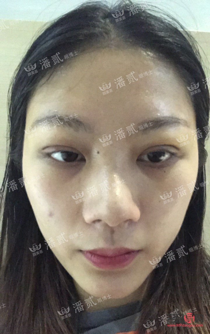 告别肿眼泡的秘诀与偏方