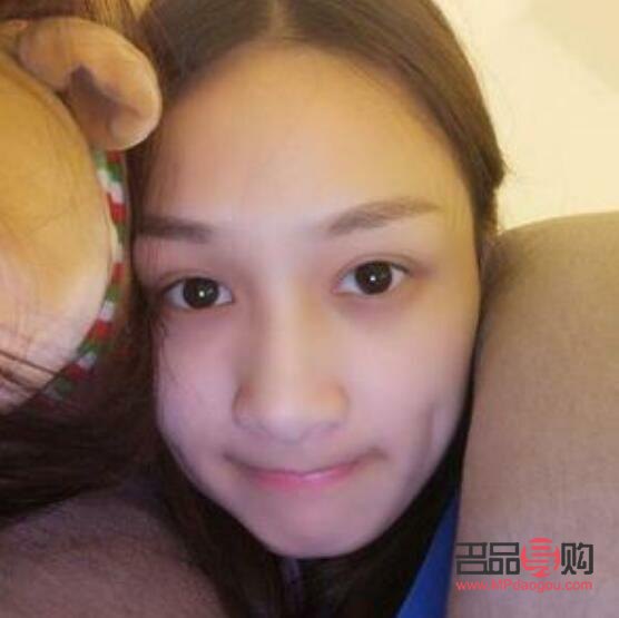 割双眼皮后多久恢复自然(割双眼皮后多久恢复自然一点) 割双眼皮后多久恢复自然(割双眼皮后多久恢复自然一点)