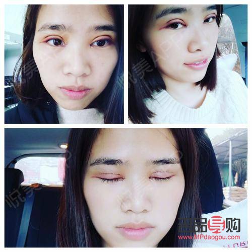 割双眼皮后多久恢复自然(割双眼皮后多久恢复自然一点)