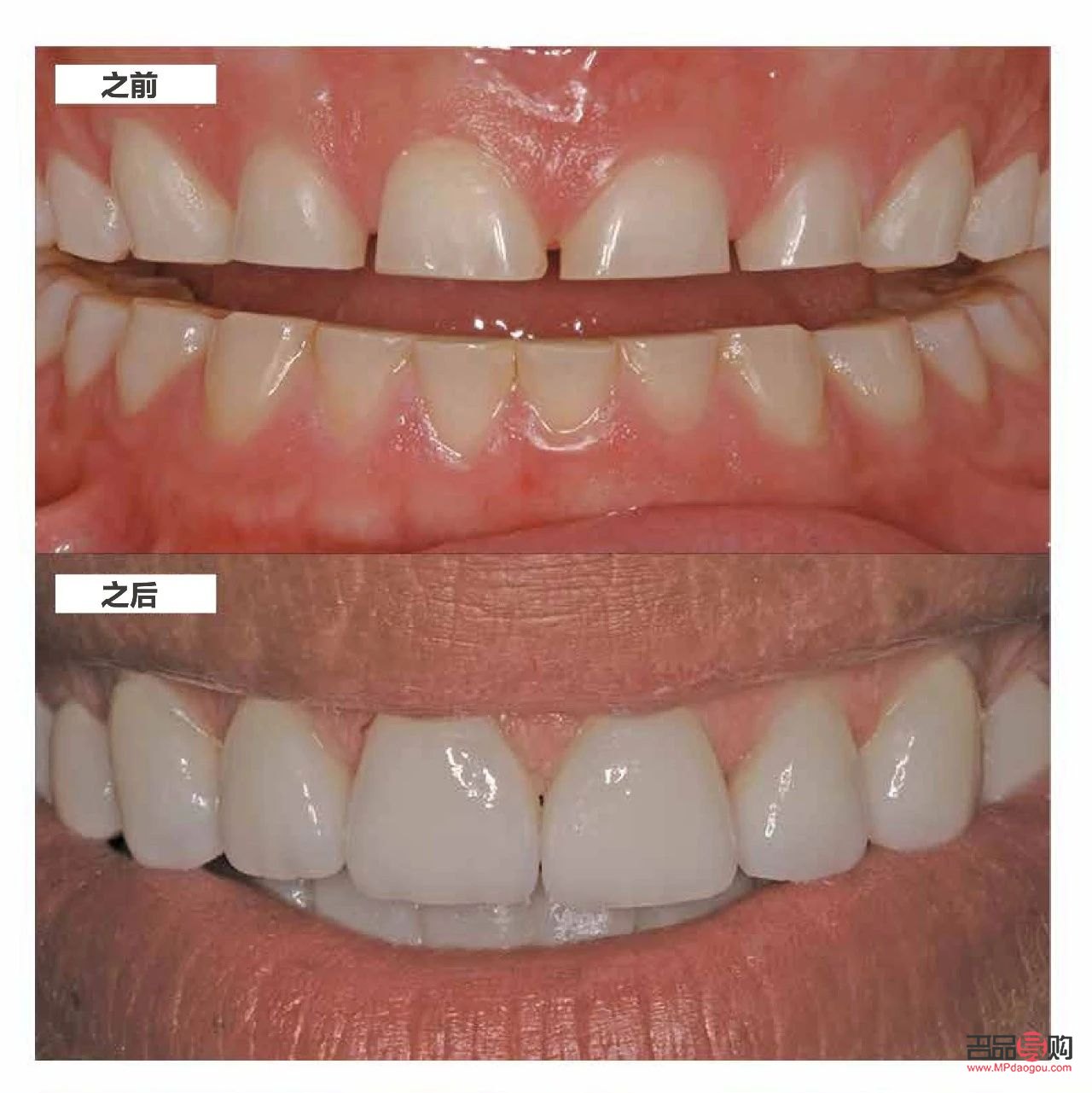 美容冠：美丽与健康的双重保障