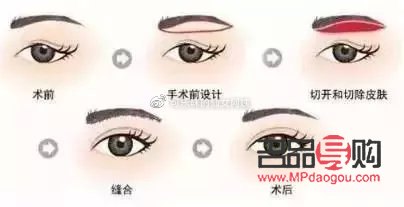 睁眼需要抬眉毛(睁眼需要抬眉毛一定得提肌吗) 睁眼需要抬眉毛(睁眼需要抬眉毛一定得提肌吗)