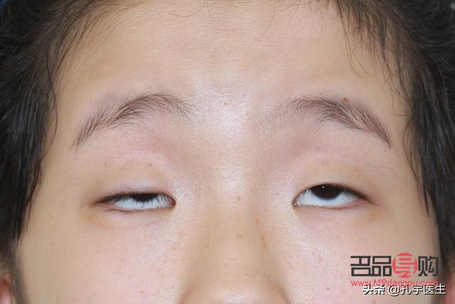 睁眼需要抬眉毛(睁眼需要抬眉毛一定得提肌吗) 睁眼需要抬眉毛(睁眼需要抬眉毛一定得提肌吗)