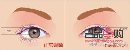睁眼需要抬眉毛(睁眼需要抬眉毛一定得提肌吗) 睁眼需要抬眉毛(睁眼需要抬眉毛一定得提肌吗)
