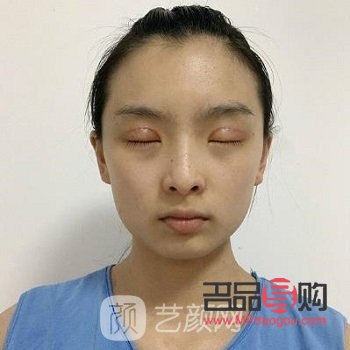 眼综合20天依然肿胀，如何应对？