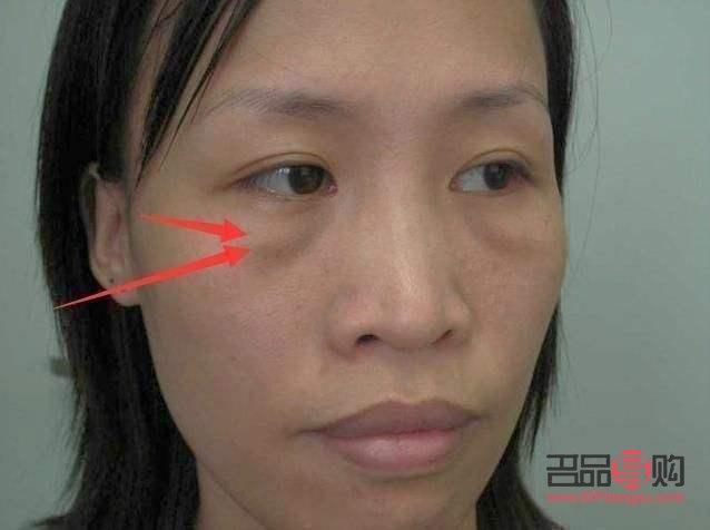 提拉眼角是不是辱华(提拉眼角多少钱)