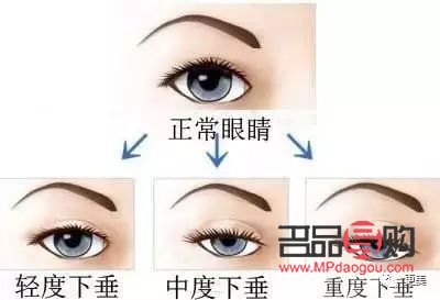 14岁内双眼皮还能不能变双眼皮(14岁双眼皮就定型了吗)