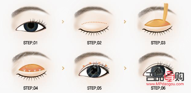 做双眼皮手术多少钱(西南医院做双眼皮手术多少钱)