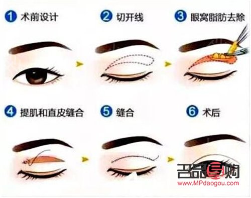 做双眼皮手术多少钱(西南医院做双眼皮手术多少钱)