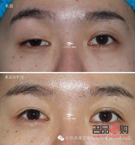 眼睑下至手术前后图片(眼睑下垂手术风险大吗) 眼睑下至手术前后图片(眼睑下垂手术风险大吗)