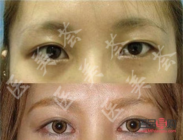 眼睑下至手术前后图片(眼睑下垂手术风险大吗) 眼睑下至手术前后图片(眼睑下垂手术风险大吗)