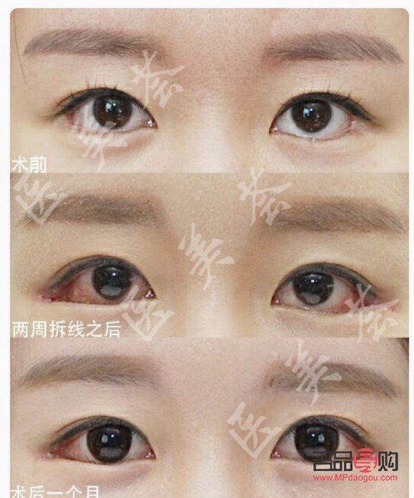 眼睑下至手术前后图片(眼睑下垂手术风险大吗)