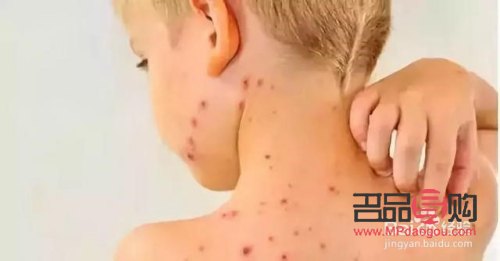 生水痘后如何护理身体(生水痘后如何护理身体好)