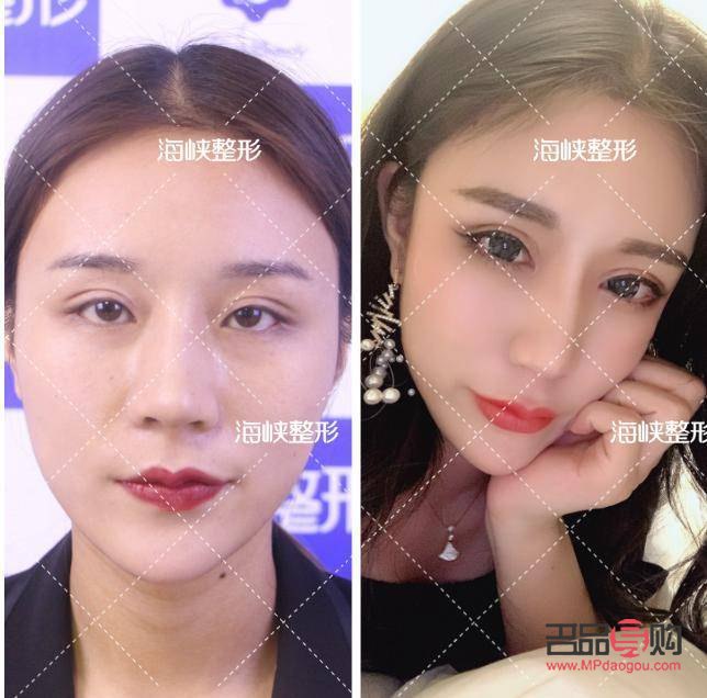 双眼皮与翘睫：美化眼部轮廓的必要步骤？