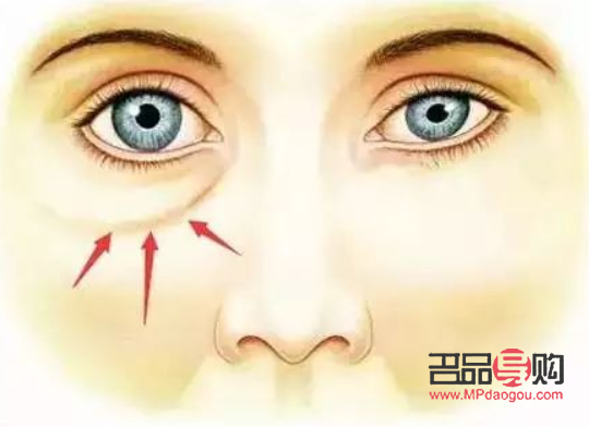 切眼袋后注意事项(去眼袋手术警惕三大后遗症)