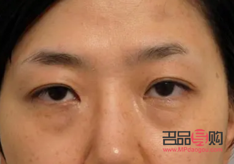 切眼袋后注意事项(去眼袋手术警惕三大后遗症)