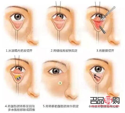 切眼袋后注意事项(去眼袋手术警惕三大后遗症)