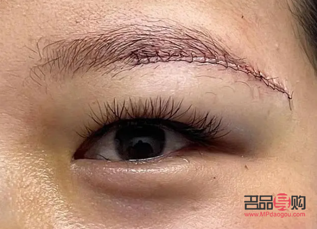 眼皮下垂是提眉好还是割双眼皮好(眼皮下垂是提眉好还是割双眼皮好呢)