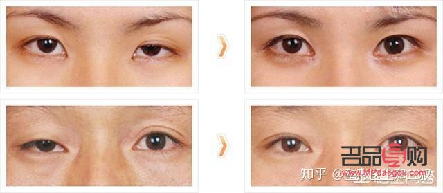 大小眼自我矫正方法最快最有效(大小眼自我矫正方法最快最有效视频)