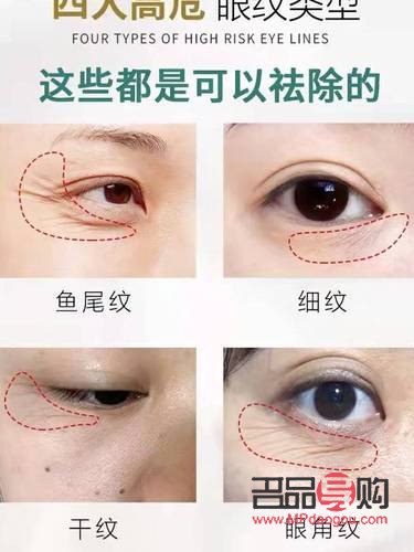 眼睛下边长皱纹是怎么回事(眼睛下边长皱纹是怎么回事儿)