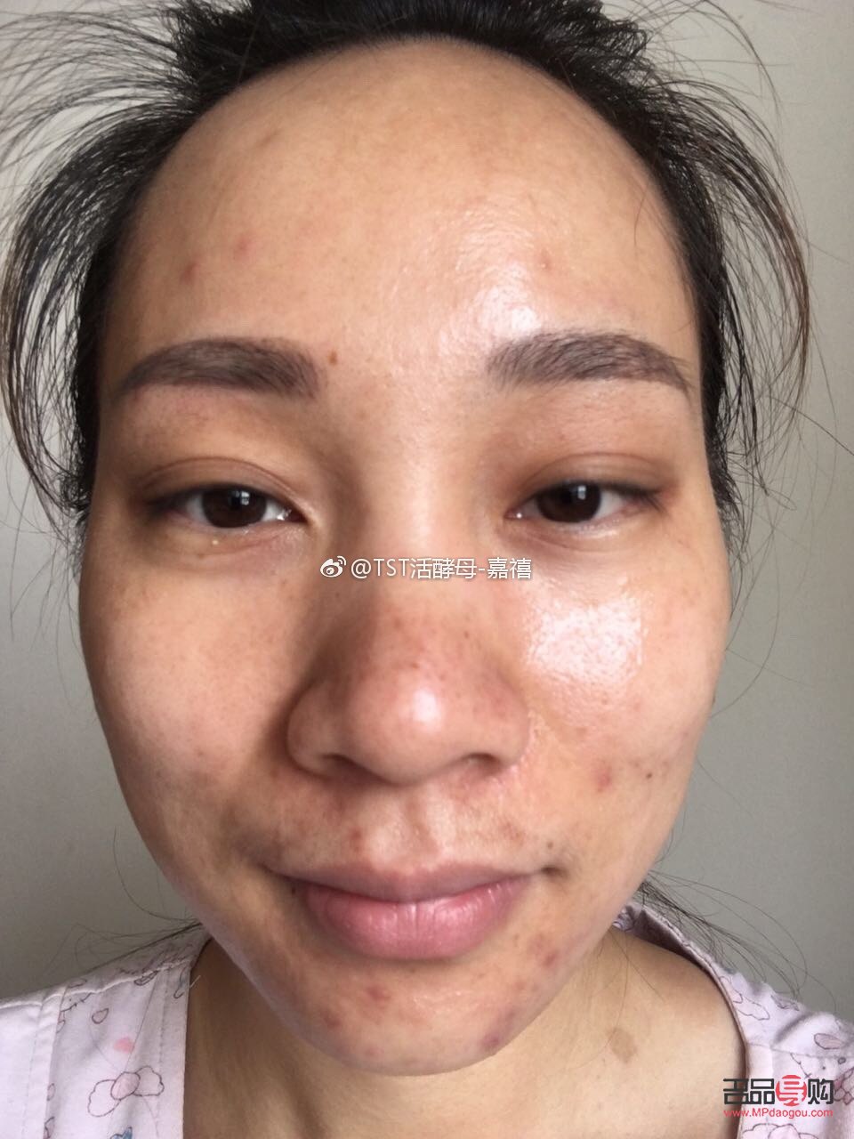 <h3>痘痘彩妆遮盖术，重拾肌肤自信</h3>