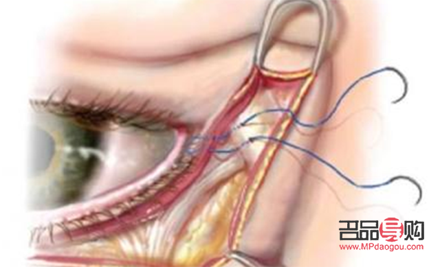 眼轮匝肌折叠卧蚕再造(眼轮匝肌折叠卧蚕再造图片) 眼轮匝肌折叠卧蚕再造(眼轮匝肌折叠卧蚕再造图片)