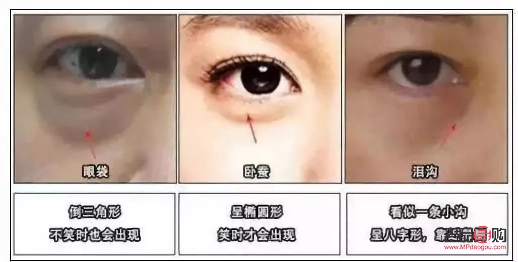 眼轮匝肌折叠卧蚕再造(眼轮匝肌折叠卧蚕再造图片)