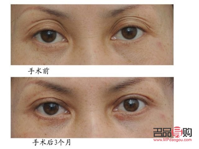 四十岁双眼皮下垂了怎么办(四十多岁变双眼皮了)