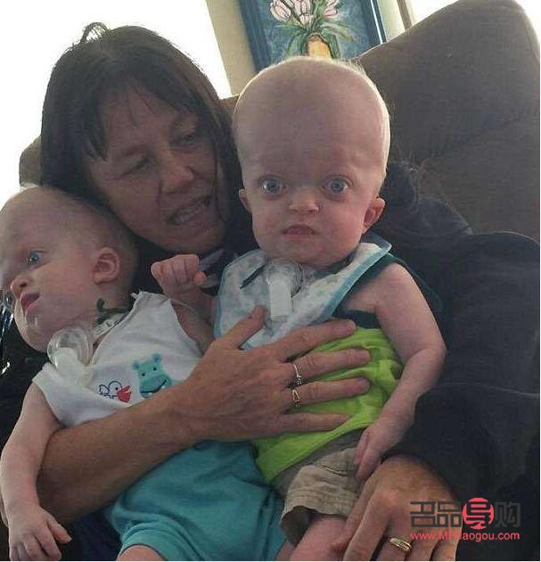 眼睛鼓突出如何改善(眼睛鼓突出是什么原因) 眼睛鼓突出如何改善(眼睛鼓突出是什么原因)