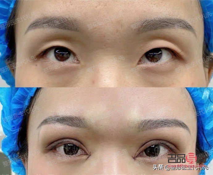 <h3>提眉与双眼皮:哪个效果更佳?</h3> <h3>提眉与双眼皮:哪个效果更佳?</h3>