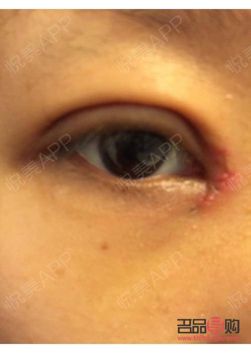 眼角痛一眨眼就痛一按也痛怎么办(眼角痛一眨眼就痛一按也痛怎么办可以用唇膏吗)