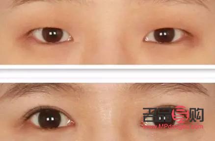 提拉眼皮的正确方法(提拉眼皮的正确方法医美)