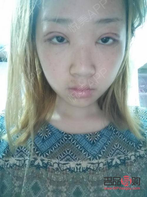 芭比眼综合是属于什么型(芭比眼综合是属于什么型状的)