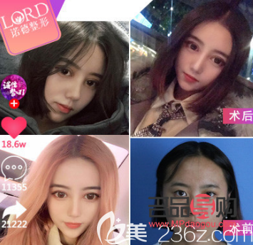 芭比眼综合是属于什么型(芭比眼综合是属于什么型状的)