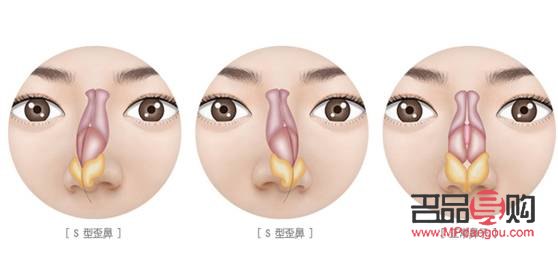 对眼矫正手术多少钱22岁(对眼矫正手术价格)