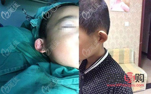 对眼矫正手术多少钱22岁(对眼矫正手术价格)