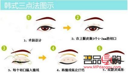 双眼皮三点定位是什么意思(双眼皮三点定位好吗)