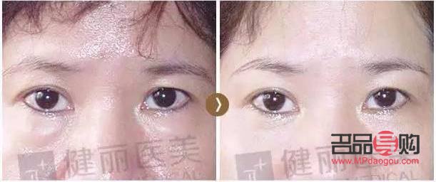 脂肪型肿眼泡怎么消除(脂肪型肿眼泡怎么消除 知乎)