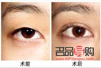 <h3>整容眼睛需要多少钱一次?了解眼部整形费用及考量因素</h3> <h3>整容眼睛需要多少钱一次?了解眼部整形费用及考量因素</h3>