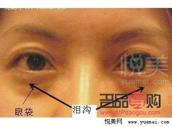 泪沟跟眼袋一样吗(泪沟跟眼袋一样吗怎么消除) 泪沟跟眼袋一样吗(泪沟跟眼袋一样吗怎么消除)