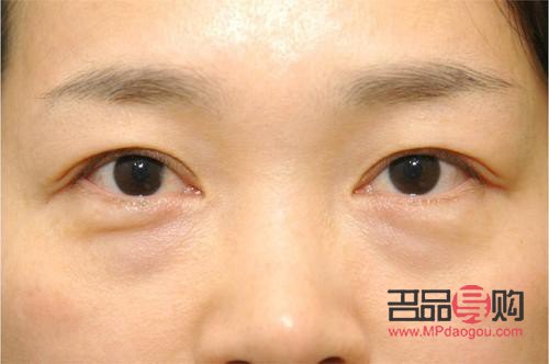泪沟跟眼袋一样吗(泪沟跟眼袋一样吗怎么消除) 泪沟跟眼袋一样吗(泪沟跟眼袋一样吗怎么消除)