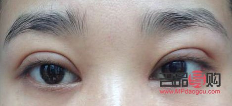 双眼皮手术风险大不大(双眼皮手术风险大不大知乎)