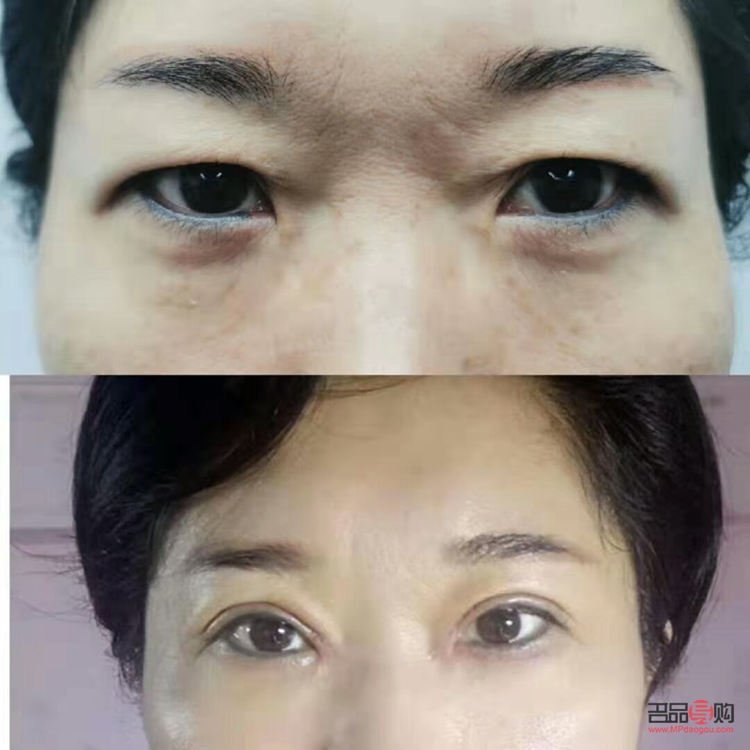 眼皮松塌怎么办(眼皮松塌怎么办小妙招) 眼皮松塌怎么办(眼皮松塌怎么办小妙招)