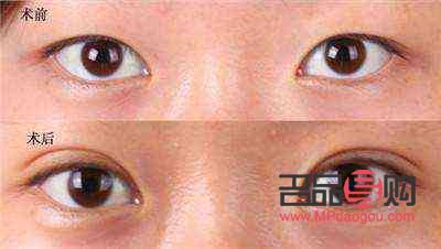 眼皮松塌怎么办(眼皮松塌怎么办小妙招)