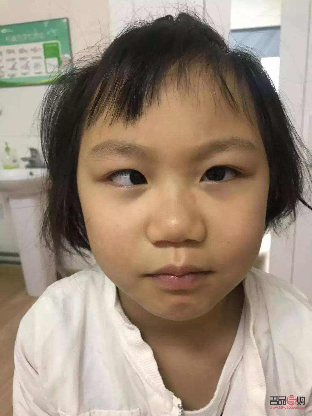 <h3>斗鸡眼矫正手术康复时间详解</h3>